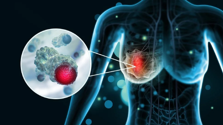 Understanding the Stages of Breast Cancer and Treatment Options
